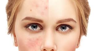 تأثیرات استرس بر صورت | علائم+درمان